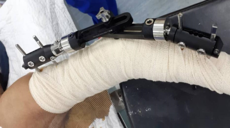 https://profiletechnology.com.my/wp-content/uploads/2025/04/Elbow-Fixator.png