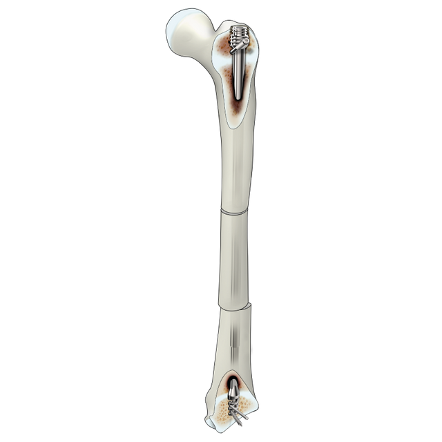 https://profiletechnology.com.my/wp-content/uploads/2025/05/D-SCOPE-Nail.png